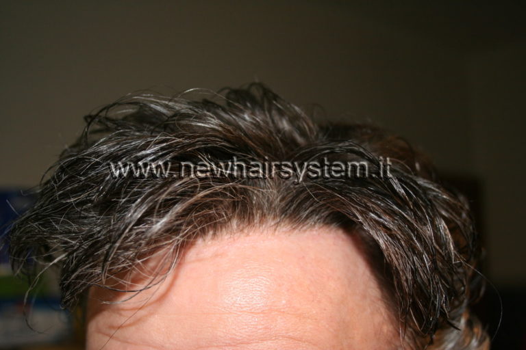 Protesi capelli in lace - New Hair System