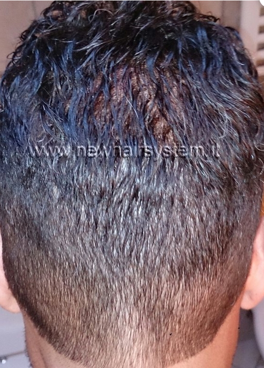 impianti capelli uomo